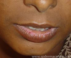 Vitiligo-OnTreatment